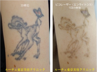 腕のタトゥービフォーアフター カラータトゥー3色（黒・ピンク・紫）の経過＿