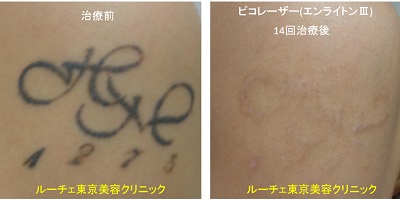 実は白が入っていたタトゥー＿