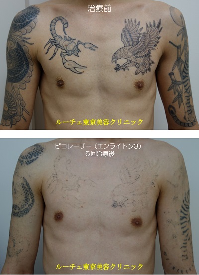 胸から両肩の広範囲タトゥーを薄くしています＿