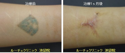 切除によるタトゥー除去