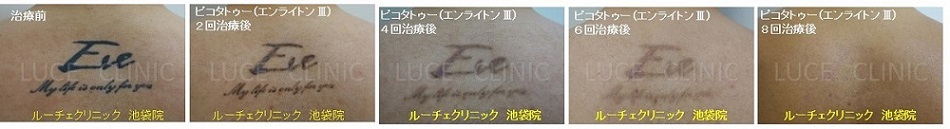 タトゥー除去ピコレーザー、８回、背中、黒、経過