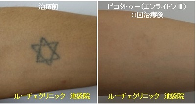 タトゥー除去ピコレーザー、４回、胸～腕、黒