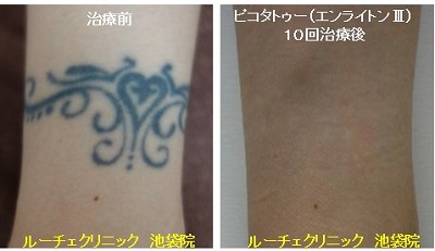 タトゥー除去ピコレーザー、1回、指、黒