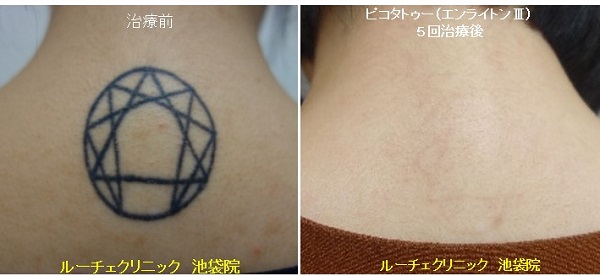 タトゥー除去ピコレーザー、1回、腕、黒