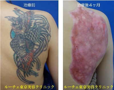 背中のカラータトゥーに削皮術を行いました＿