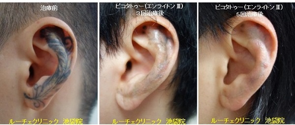 タトゥー除去ピコレーザー、10回、腕、黒、赤