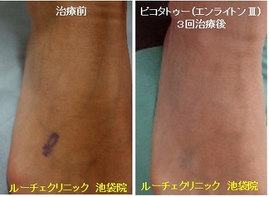 タトゥー除去ピコレーザー、1回、胸、黒