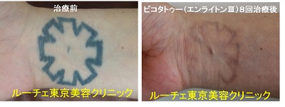 手首の濃いタトゥーが消えてきました。＿