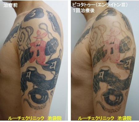 ゥー除去ピコレーザー、手首、4回、黒