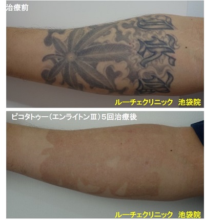 タトゥー除去ピコレーザー、足、7回、青