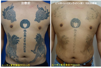 胸からお腹にかけて広範囲にある複数のタトゥーを同時に薄くしています＿