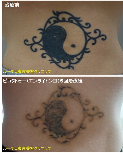 黒くベタッとしたタトゥーが5回の治療で薄くなりました