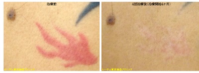 赤と黒の背中のタトゥー