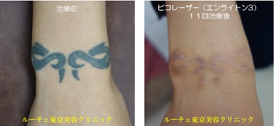 手首のタトゥーを１１回ピコレーザーで治療しました＿