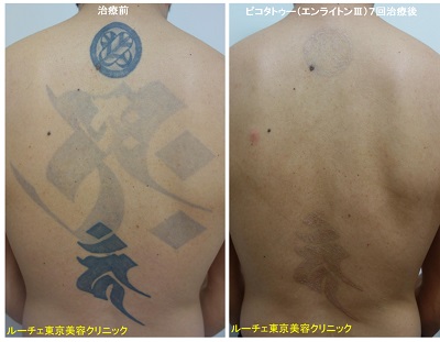 背中一面の黒タトゥーが薄くなりました＿