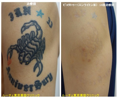 腕の黒・青・赤3色タトゥーが目立ちにくくなりました＿