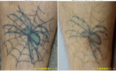 クモの2色タトゥー、黒、緑