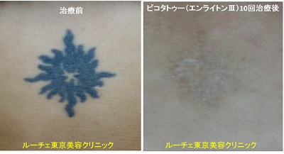 腰の濃いべったりタトゥーが目立たなくなりました、とれた