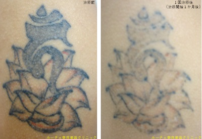 ピコレーザータトゥー除去経過　腕２色黒赤1回照射後＿