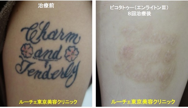タトゥー除去ピコレーザー、足、8回、黒、赤、とれた