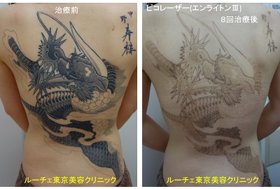 １度の治療で背中ほぼ全体の治療が可能です。８回照射しました