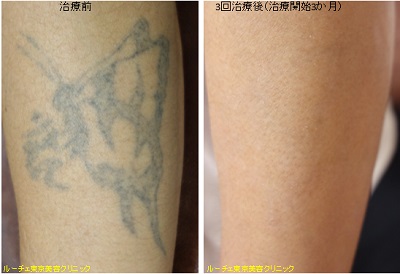 腕の黒タトゥー、とれた