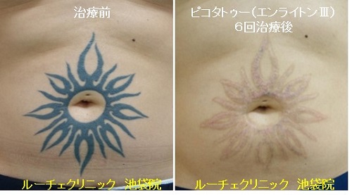 タトゥー除去ピコレーザー、12回、腕、黒、赤、黄色