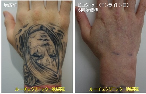 タトゥー除去ピコレーザー、3回、足、黒