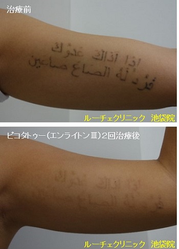 タトゥー除去ピコレーザー、4回、手首、黒