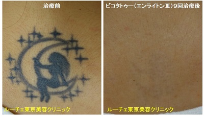 うなじの黒一色タトゥーが消えました、とれた