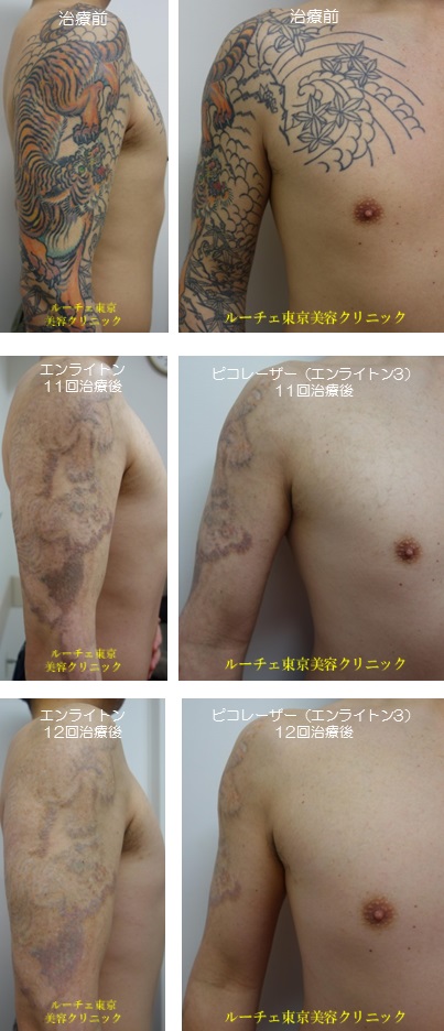 腕のカラータトゥー。色がなくなっていく経過。カラータトゥー10色＿