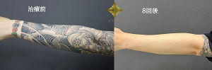 腕のタトゥーとれました　８回　黒　腕
