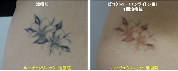 タトゥー除去ピコレーザー、指、4回、黒