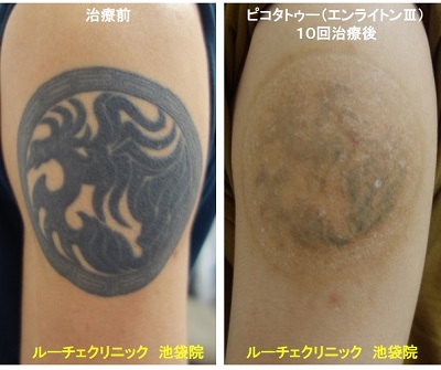 タトゥー除去ピコレーザー、背中、１回、黒