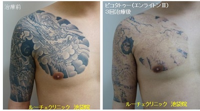 タトゥー除去ピコレーザー、1回、指、黒