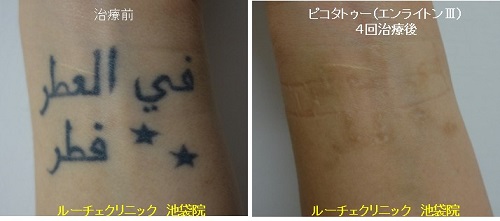 タトゥー除去ピコレーザー、足甲、6回、黒