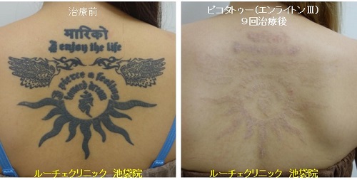 タトゥー除去ピコレーザー、腰、4回、黒、水色