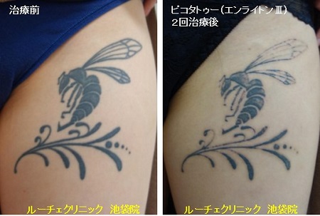 タトゥー除去ピコレーザー、7回、腰、黒