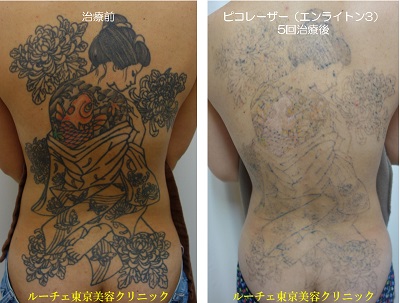 背中の広範囲カラータトゥーにピコレーザーを当てました＿