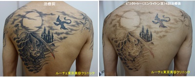 背中一面の黒と赤２色タトゥーが薄くなります　4回背中黒赤