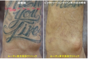 シャツからはみ出る手首のタトゥーがほとんど分からなくなりました＿