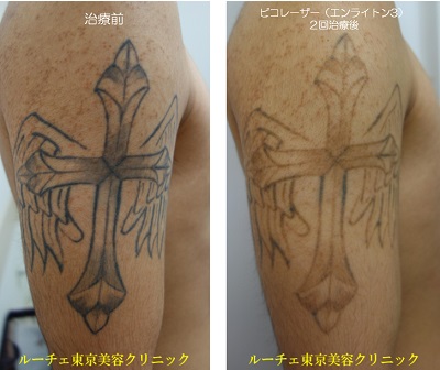 腕の黒一色タトゥーが2回の治療でかなり薄くなりました＿