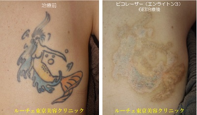 背中カラータトゥー（水色・黒・オレンジ・黄色）＿