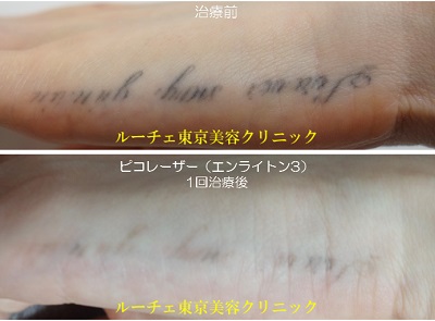手の黒いタトゥーの治療後写真です＿