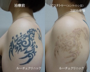 タトゥー除去ピコレーザー3回、左肩、黒。