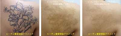 背中の ピコレーザー治療後の色素沈着が消えていく過程経過＿