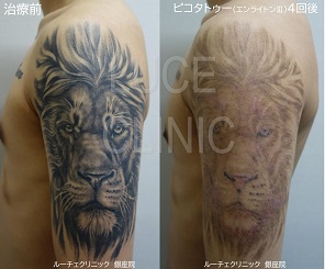 タトゥー除去ピコレーザー、7回、腕