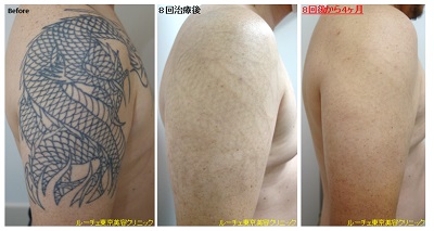 腕の黒１色タトゥーでピコレーザー終了＿