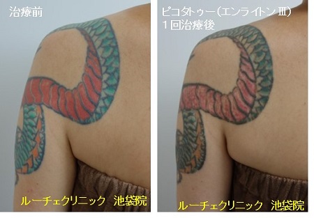 タトゥー除去ピコレーザー、5回、足、黒