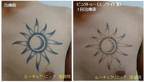 タトゥー除去ピコレーザー、3回、腕、黒